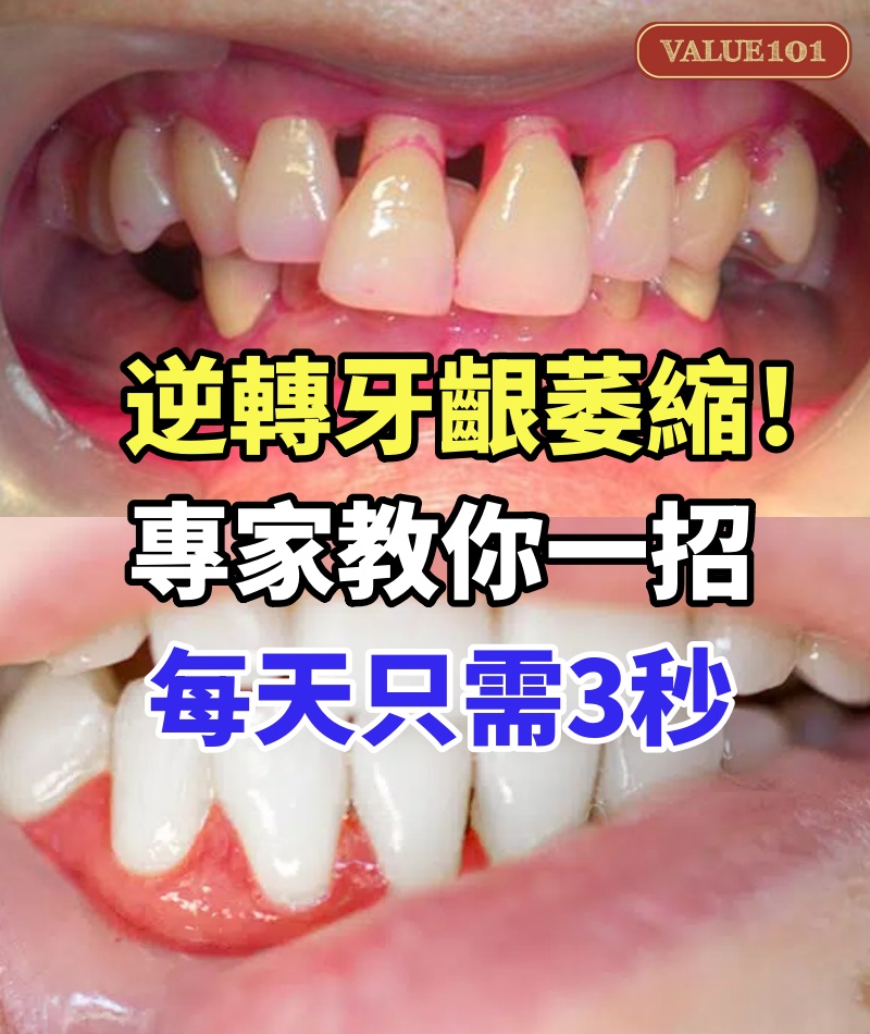 逆轉牙齦萎縮！專家教你一招，每天只需3秒，牙肉悄悄長回來，從此告別牙周病！