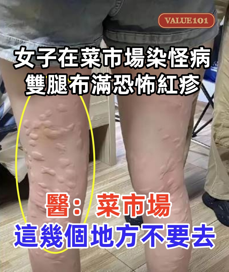 女子PO出菜市場染「怪病」照片！雙腿布滿恐怖紅疹，醫生檢查后揭秘：菜市場這幾個地方不要去！