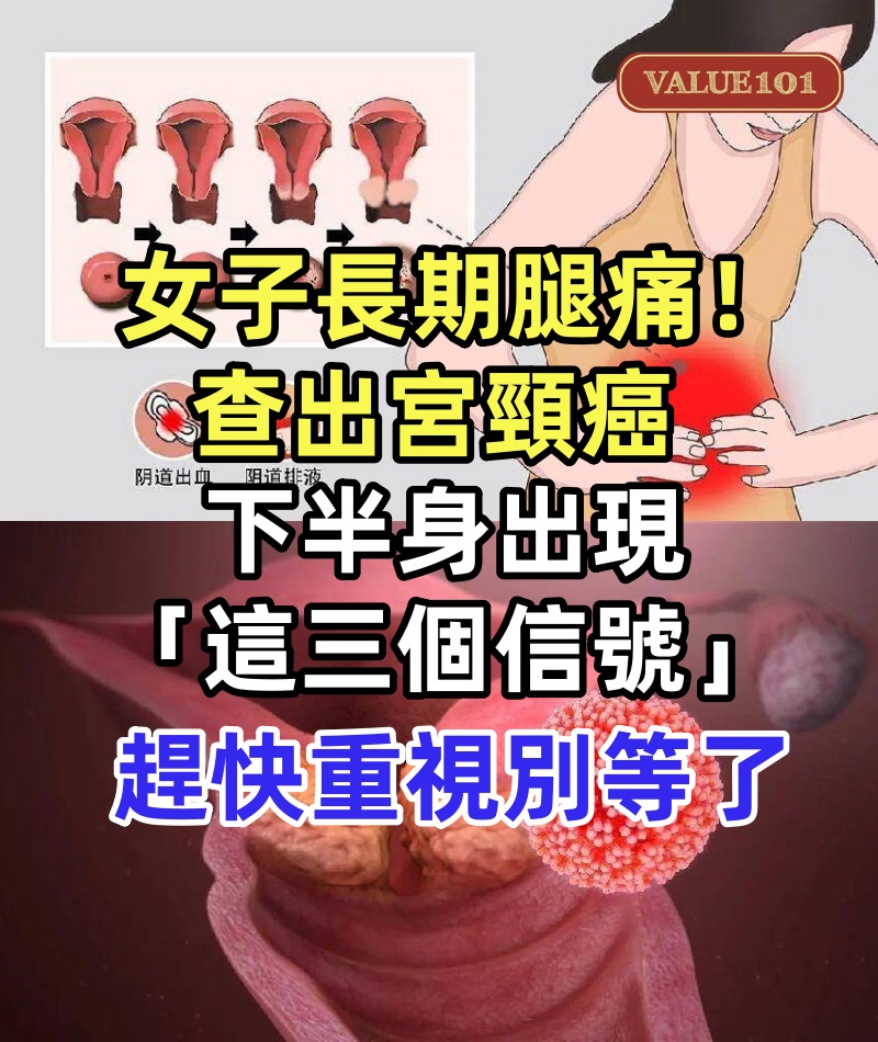 55歲女子長期腿痛！查出宮頸癌　下半身出現「這三個信號」：趕快重視別等了