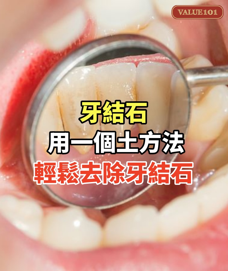 牙結石不要花錢去洗牙!用一個土方法,自己家裡輕鬆去除牙結石!牙結石全部清理乾淨!