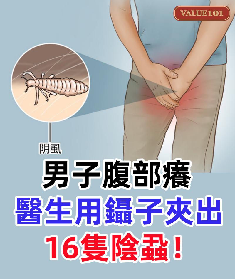 男子腹部癢,醫生用鑷子夾出16隻陰蝨!原來陰蝨有3條傳播途徑