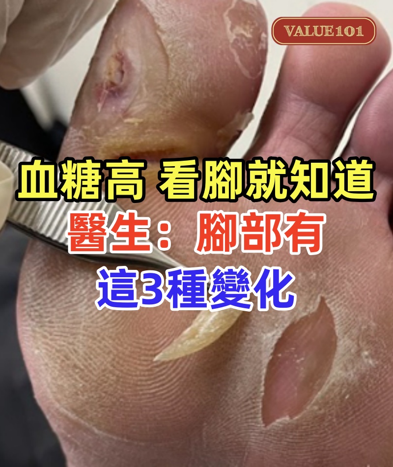 血糖高了,看腳就知道,醫生:腳部有這3種變化,提醒你該降糖了