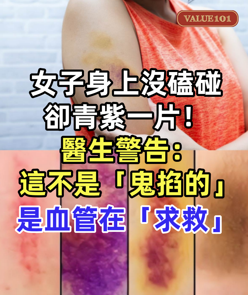 女子身上沒磕沒碰卻青紫一片！醫生警告：這不是「鬼掐的」是血管在「求救」