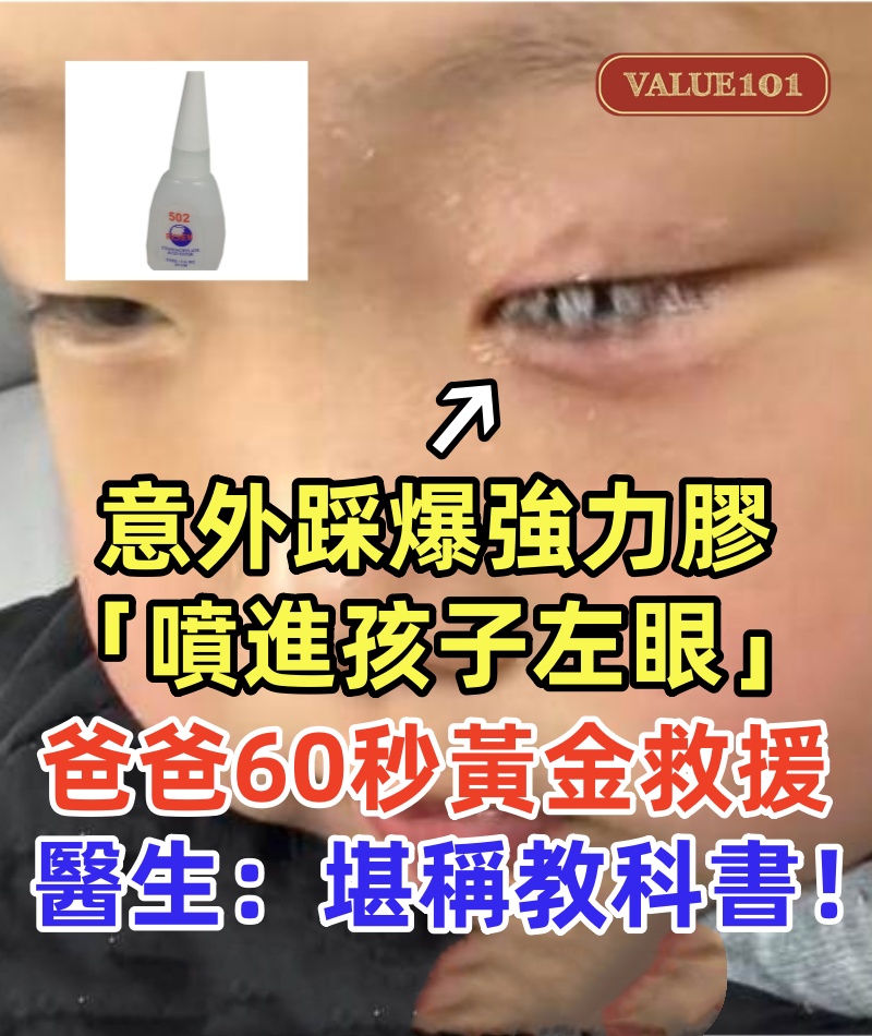 意外踩爆強力膠「噴進孩子左眼」被粘牢，爸爸60秒黃金救援，醫生：堪稱教科書！
