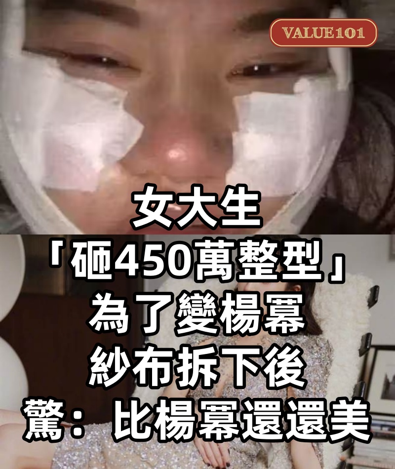 女大生「砸450萬整型」為了變楊冪， 紗布拆下後，驚：比楊冪還還美